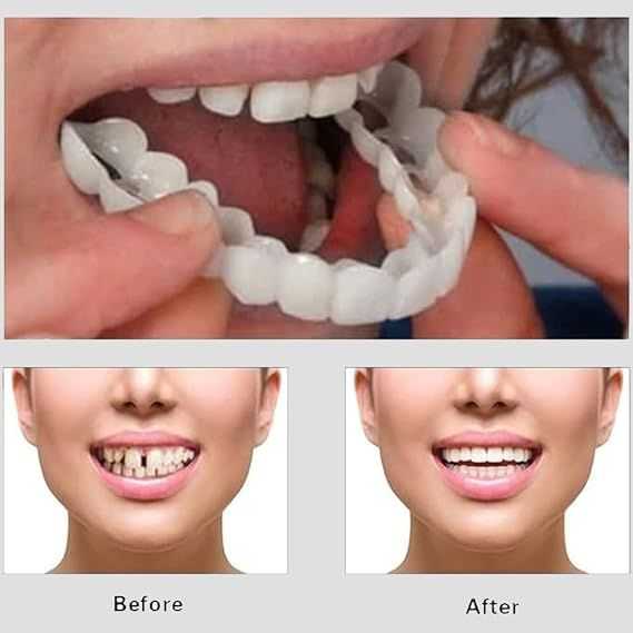 Snap-On Smile Veneers (Unisex)